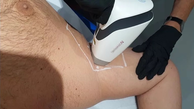 Épilation homme